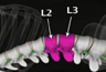 Disc Herniation