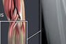 Fractured Ulna