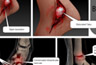 Spinal Surgery